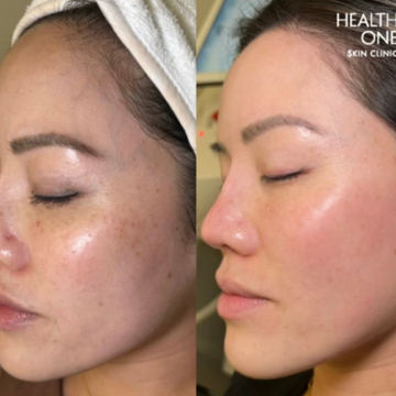 CUTE-E Cream for Melasma & Freckles | Fades Pigmentation, Dark Spots & Brightens Skin